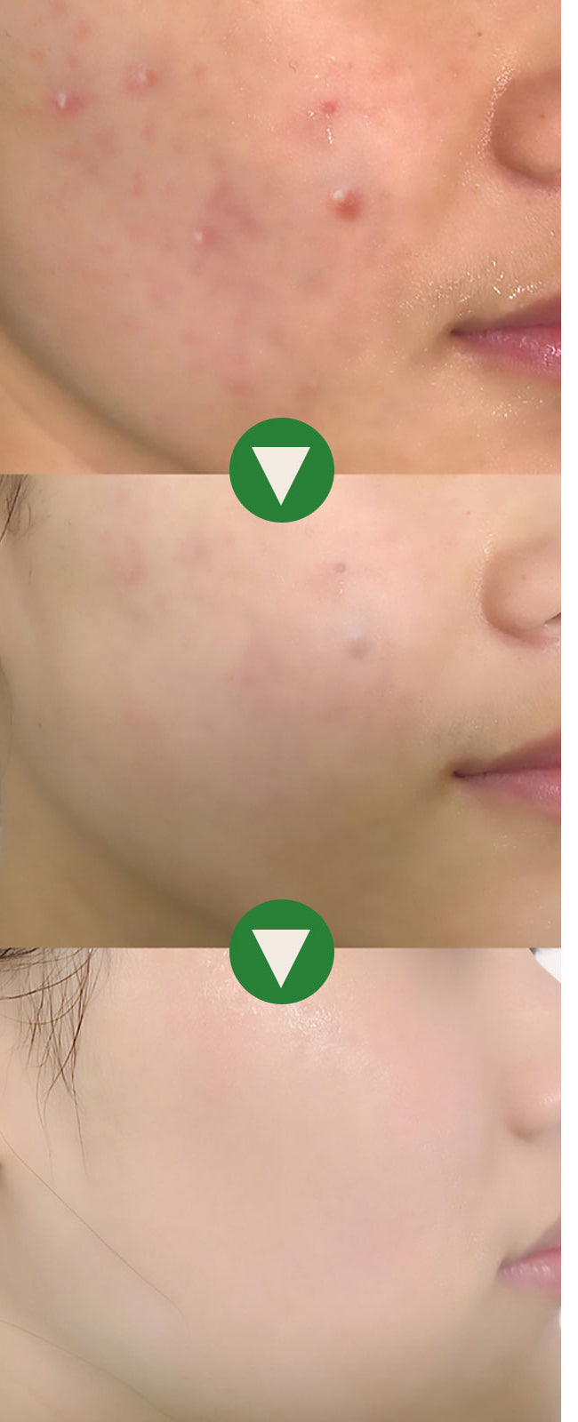 Close-up comparison of blemish-prone cheek skin