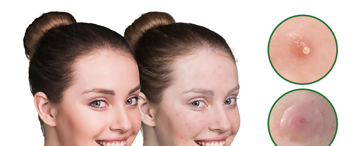 Clear skin and blemish-prone skin compared, with a magnified view of a hydrocolloid patch over a pimple